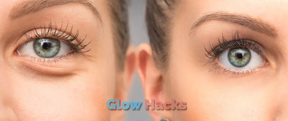 How to Fix Dark Circles Under Eyes Naturally 1