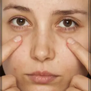 How to Fix Dark Circles Under Eyes Naturally 1