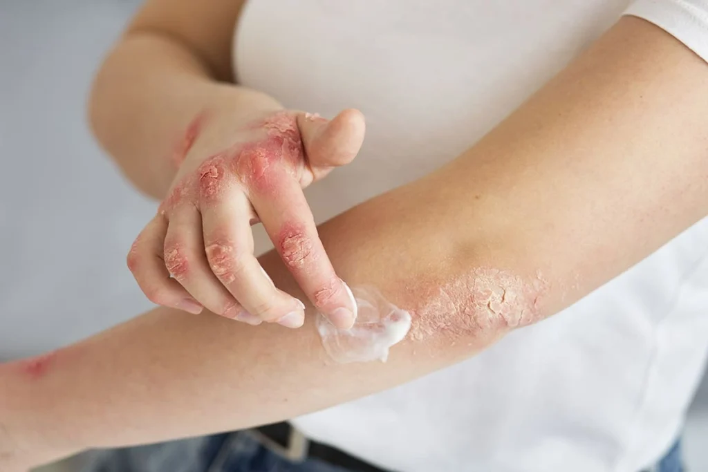 Person applying cream to red, irritated skin on hands and arms due to super glue reaction