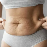 Loose abdominal skin being pinched by a woman after weight loss, showing excess skin around the stomach area