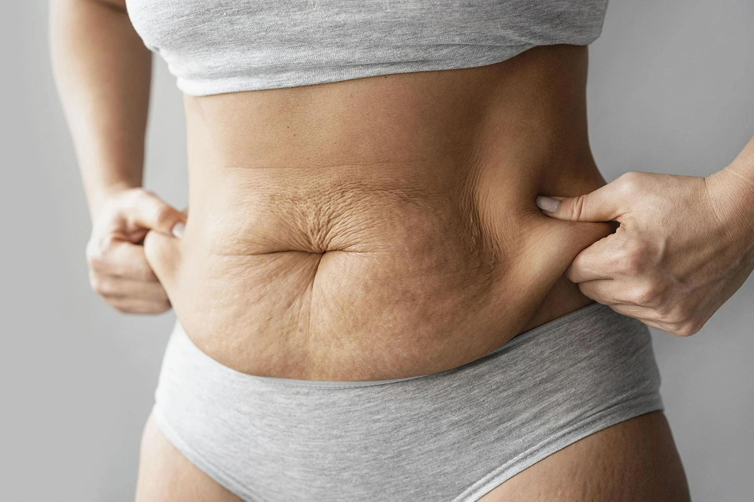Loose abdominal skin being pinched by a woman after weight loss, showing excess skin around the stomach area